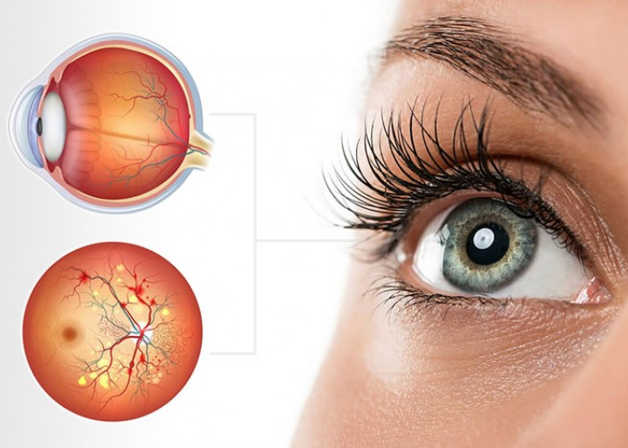 Retina Cerrahisi-1