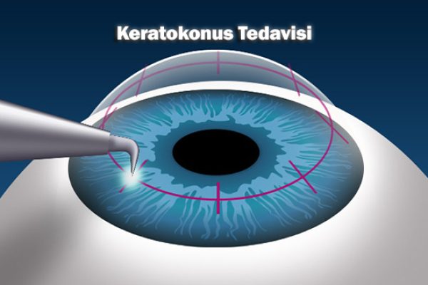 keratoplasti
